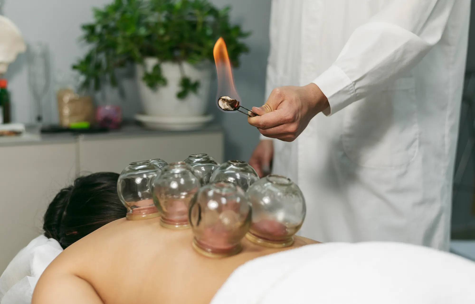 Therapeutic Cupping at Velocity Physical Therapy